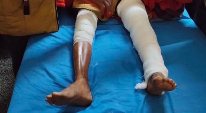 StreetBuzz *वृद्ध महिला के टूटे पैर का ऑपरेशन करने के बजाय डॉक्टर ने कर दिया  दूसरे पैर का ऑपरेशन,मचा हड़कंप* sultanpur