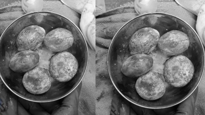 Visakhapatnam bladder stones
